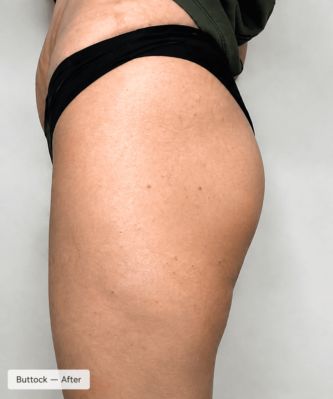 Body contour — Before