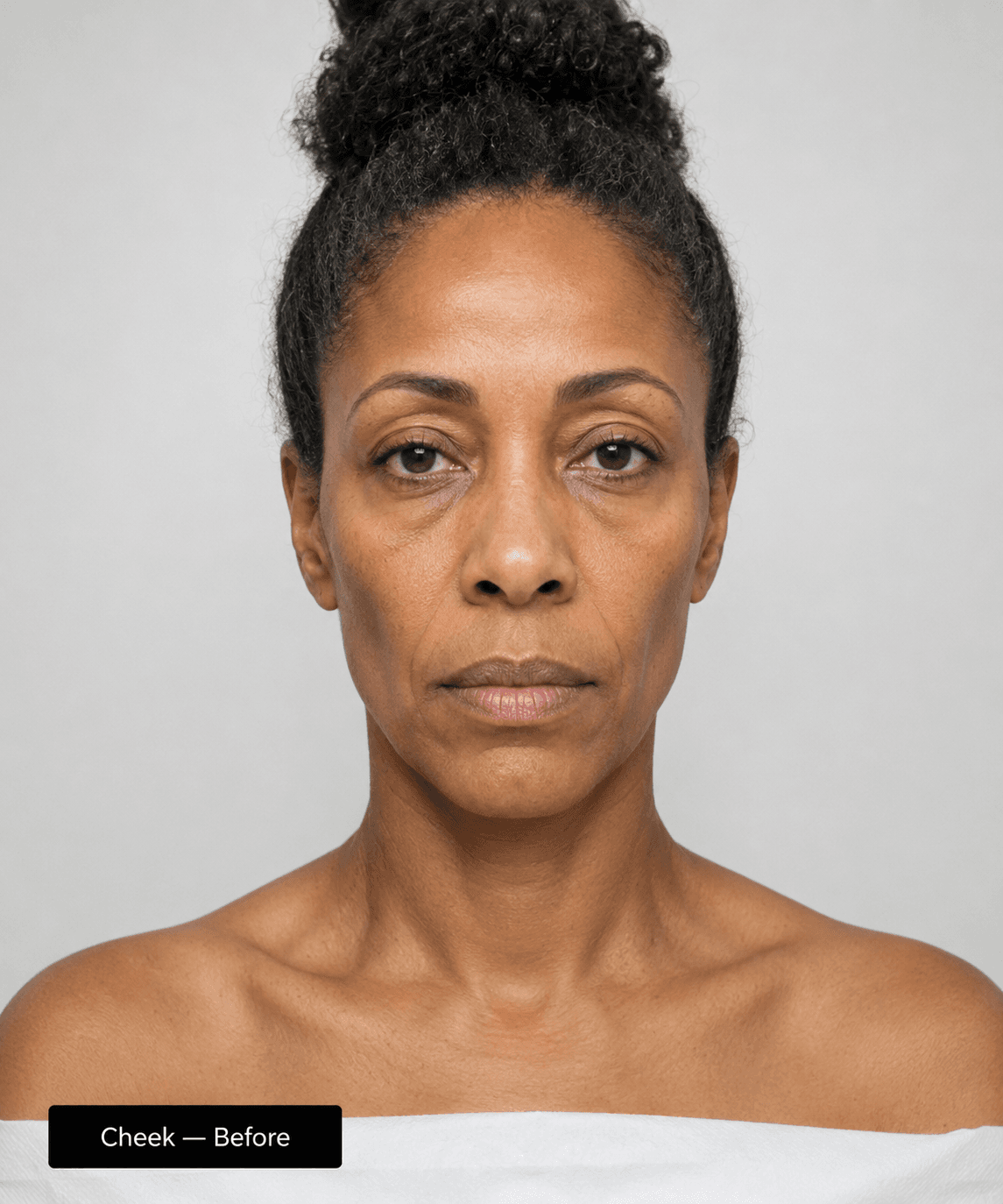 Cheek contour — Before