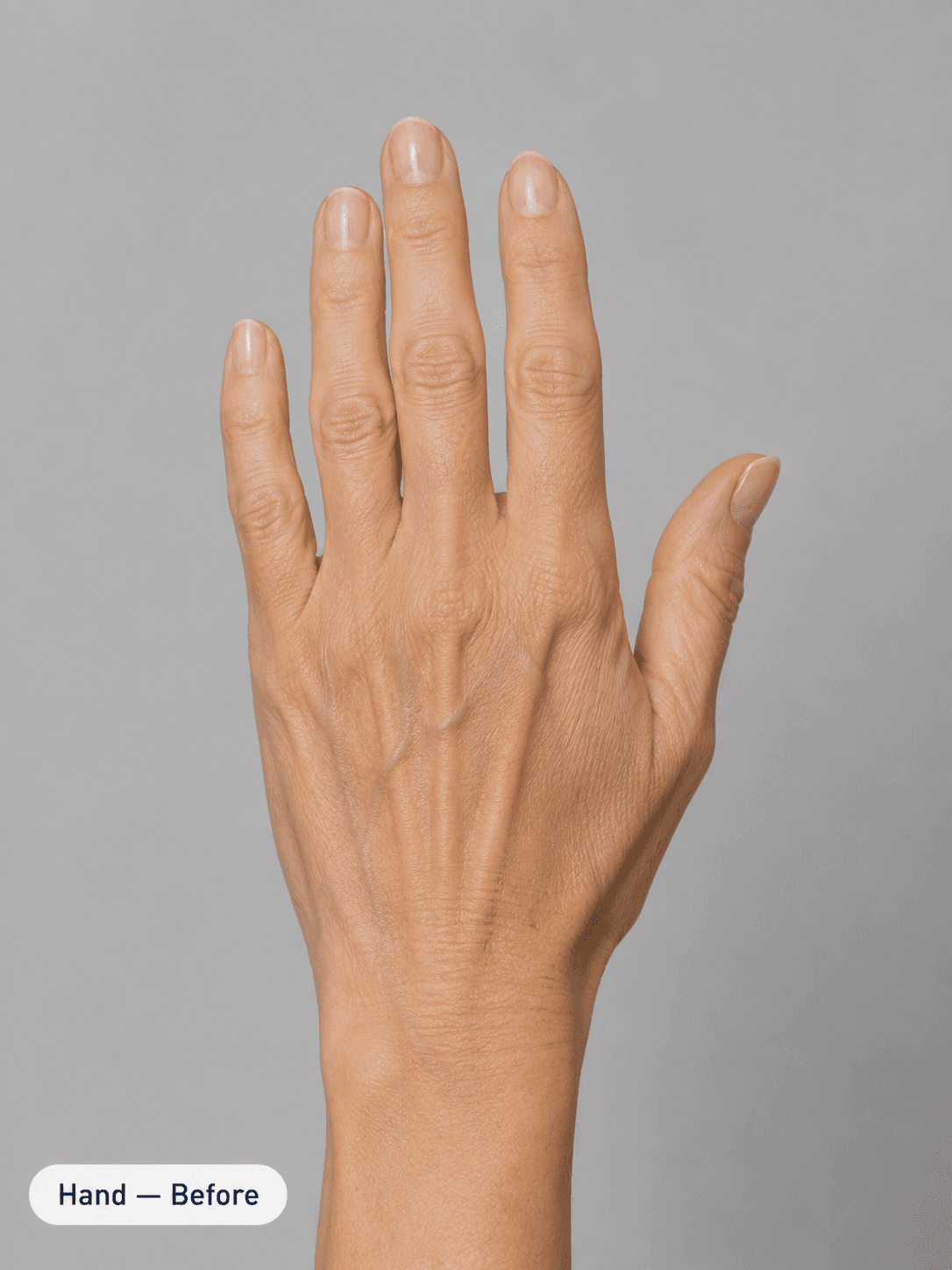 Hand rejuvenation & brightening — Before