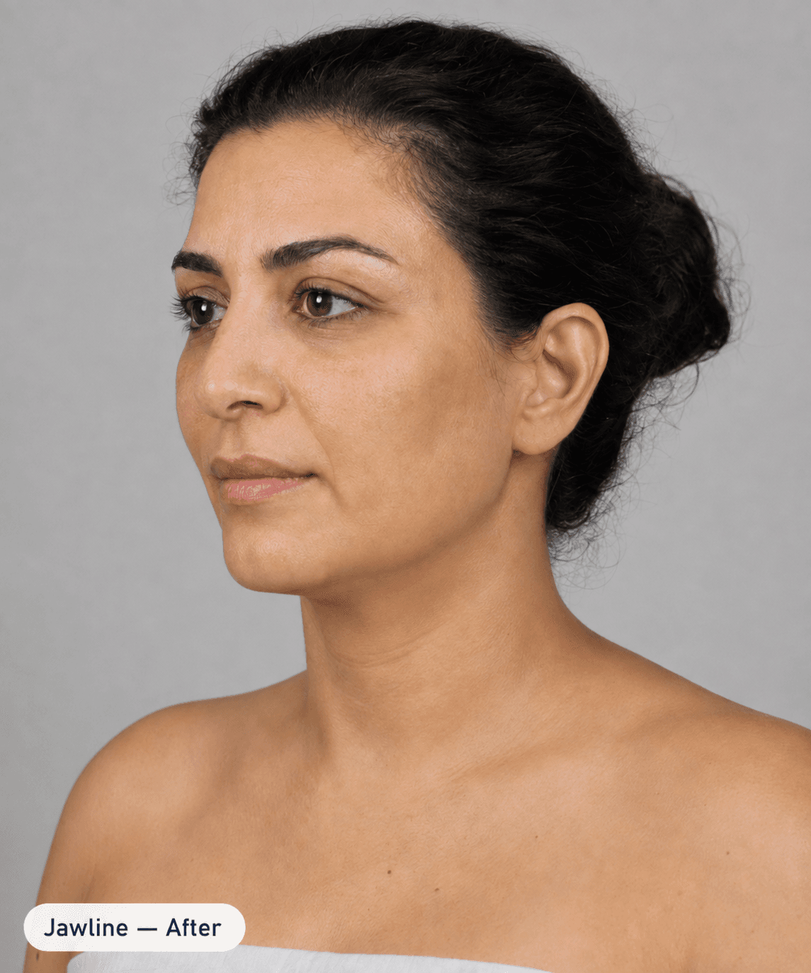 Jawline contour — After