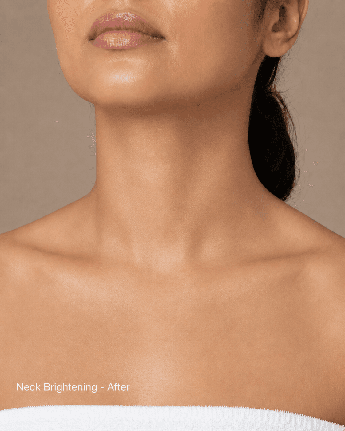 Neck & décolleté rejuvenation — After