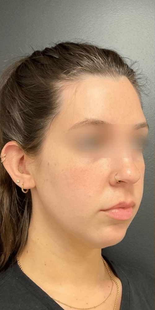 Jawline Refinement — Before