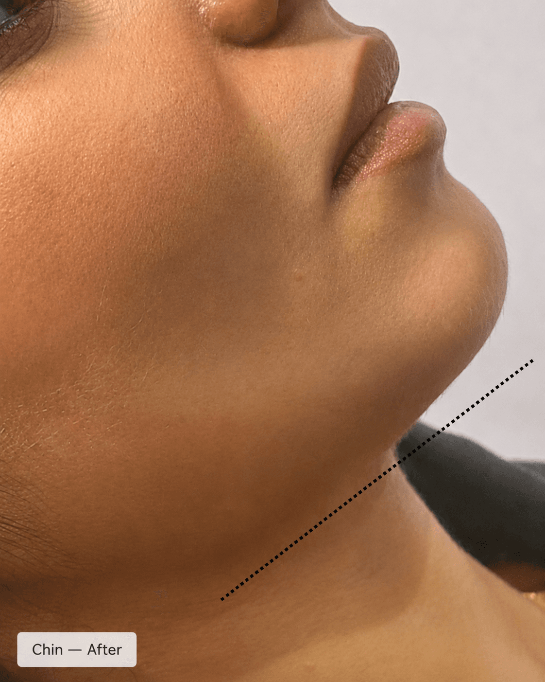 Chin Projection — Before