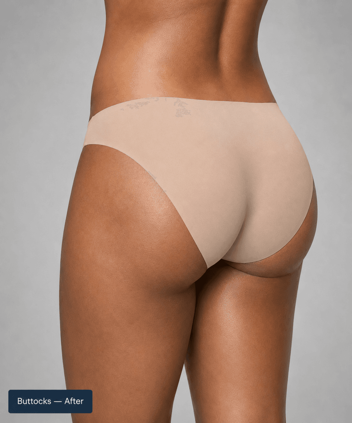 Buttocks contour — After