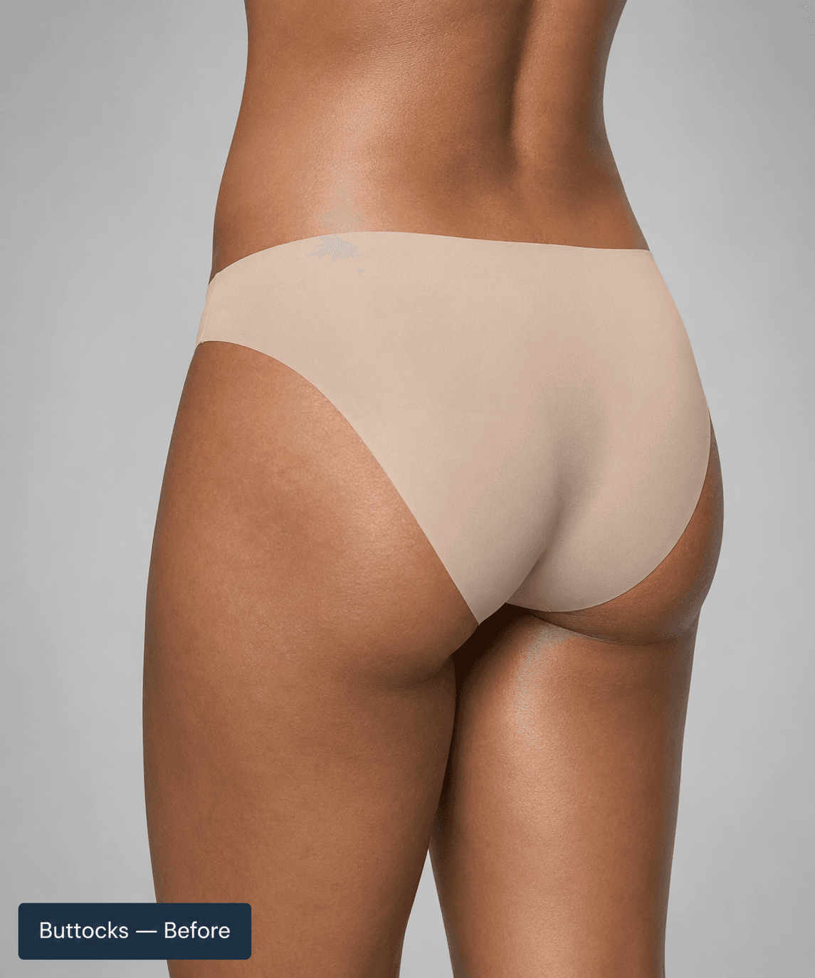 Buttocks contour — Before