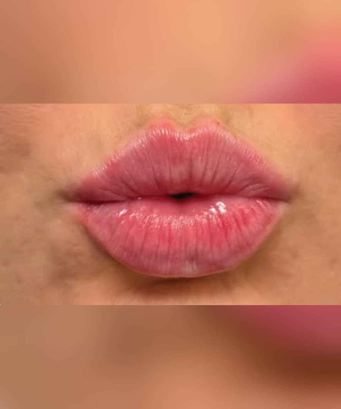 Lip plumping & hydration — After